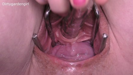 Close up Urethra Cervix Prolapse small screenshot